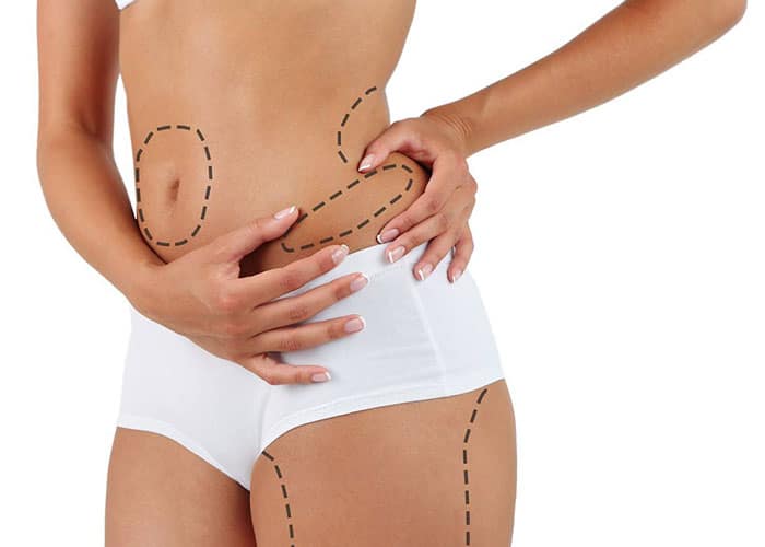 Tummy-Tuck