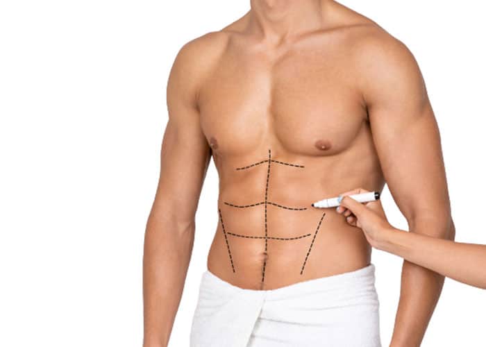 Male-Liposuction